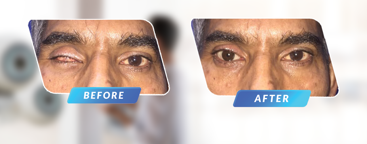 artificial eye before-after